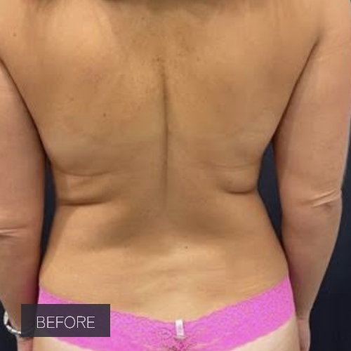 Procedure before and after - before