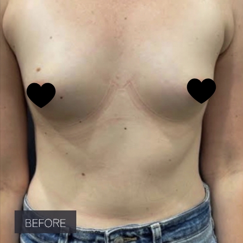 Procedure before and after - before