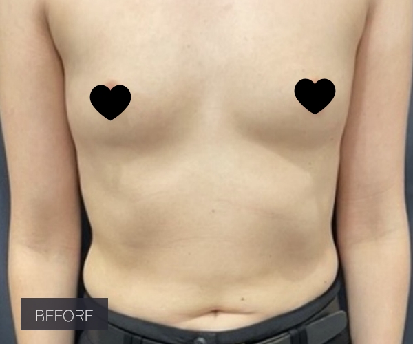 Procedure before and after - before