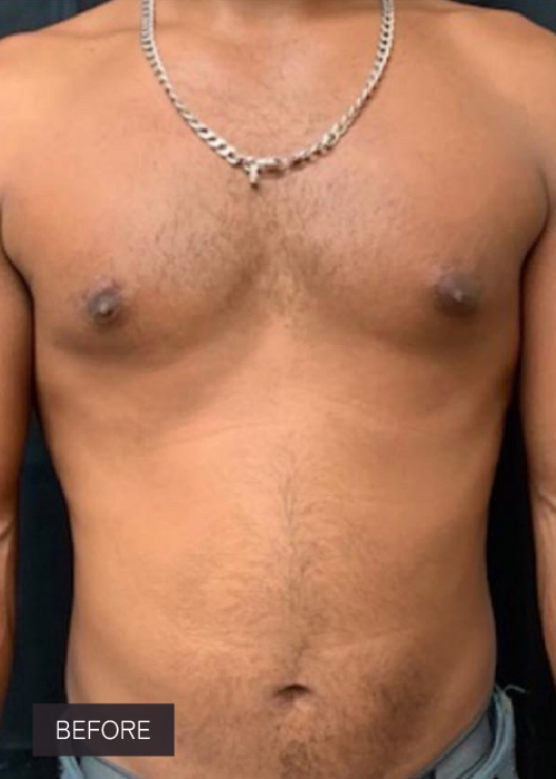 Procedure before and after - before