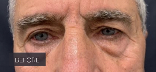 Procedure before and after - before