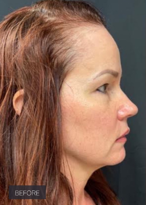 Procedure before and after - before