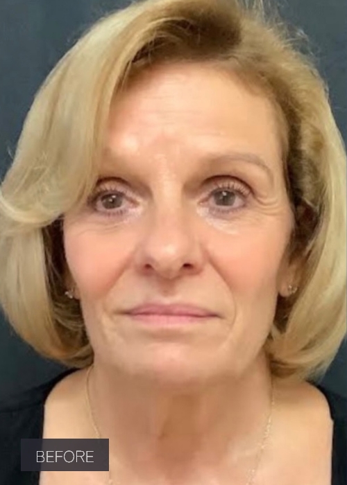 Procedure before and after - before