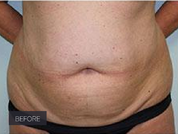 Procedure before and after - before