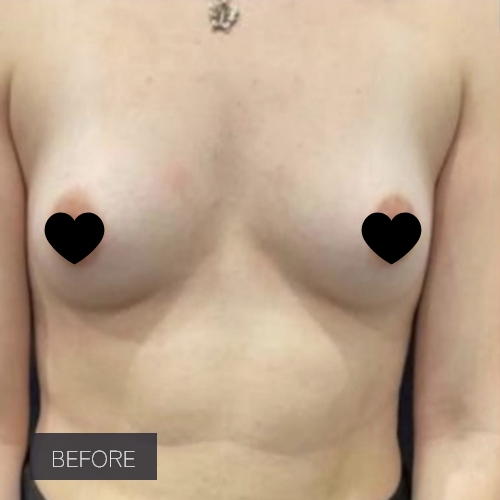 Procedure before and after - before