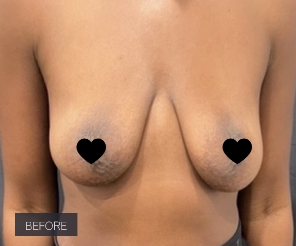 Procedure before and after - before