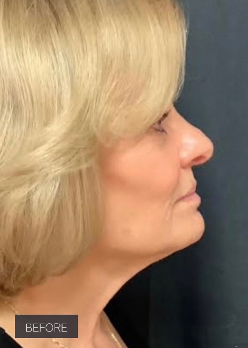 Procedure before and after - before