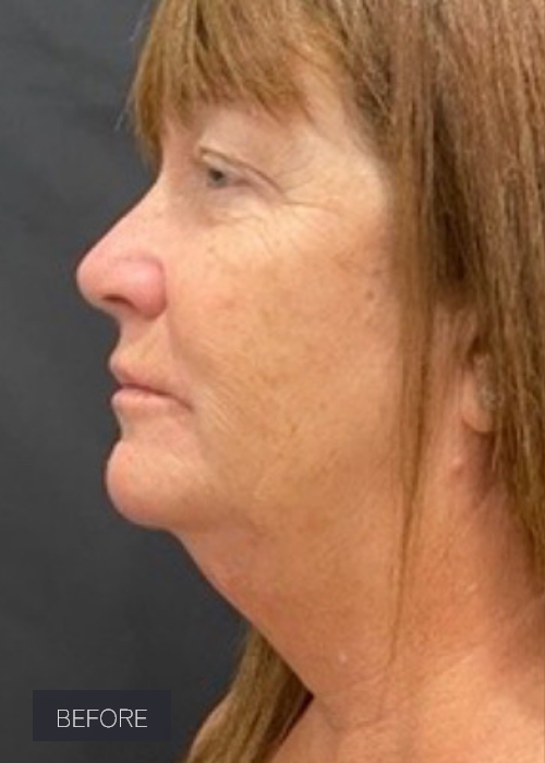 Procedure before and after - before