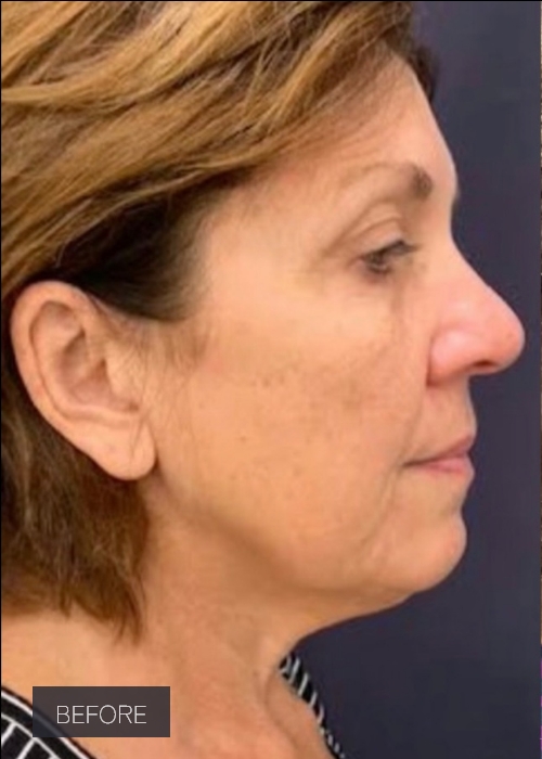 Procedure before and after - before