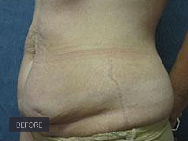 Procedure before and after - before
