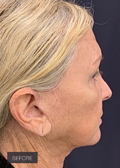 Procedure before and after - before