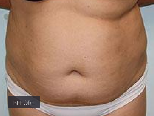 Procedure before and after - before
