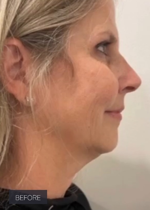Procedure before and after - before