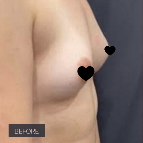 Procedure before and after - before