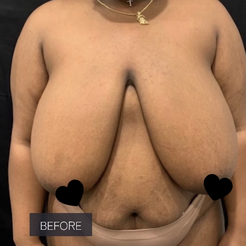 Procedure before and after - before