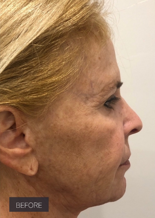 Procedure before and after - before