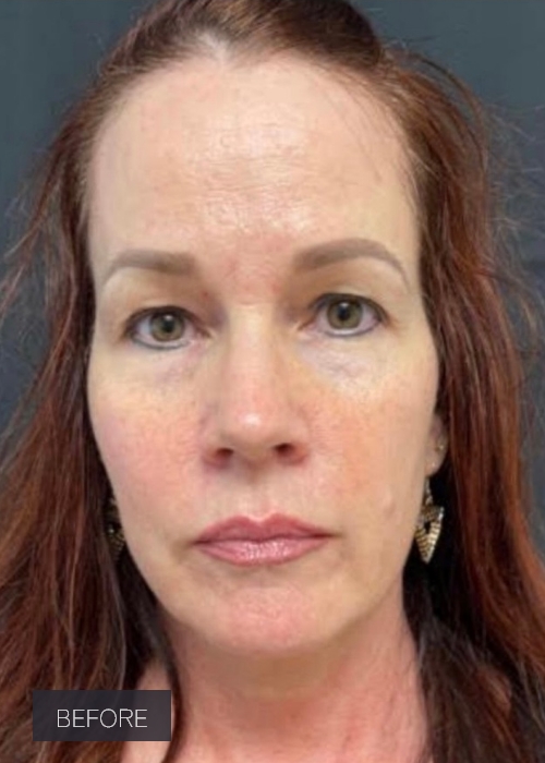 Procedure before and after - before