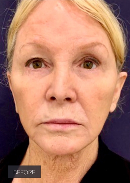 Procedure before and after - before