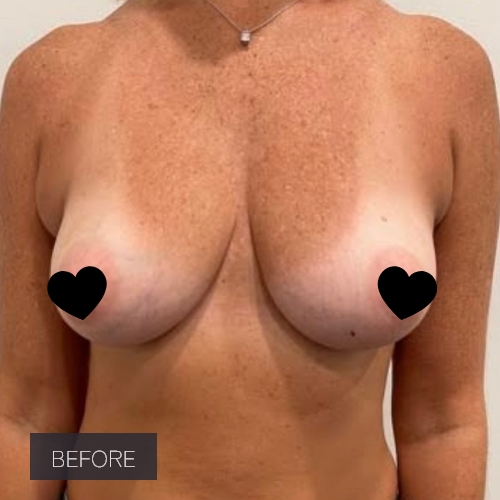 Procedure before and after - before