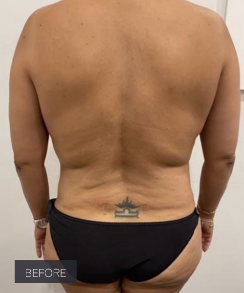 Procedure before and after - before