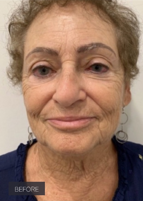 Procedure before and after - before