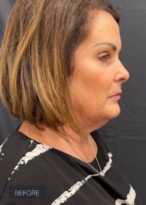 Procedure before and after - before