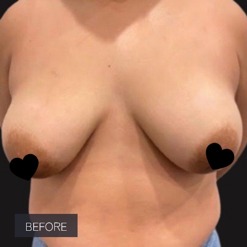 Procedure before and after - before