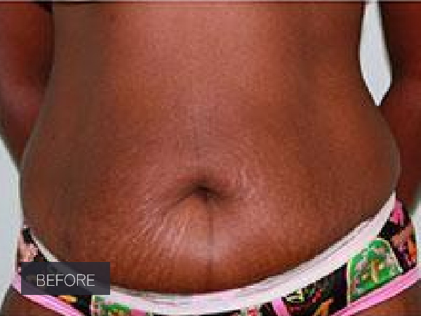 Tummy Tuck before and after - before