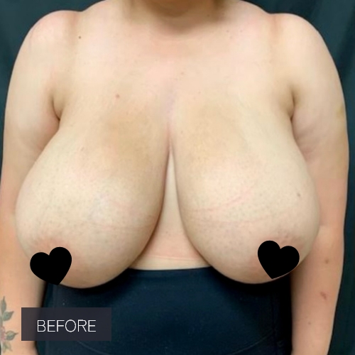 Procedure before and after - before