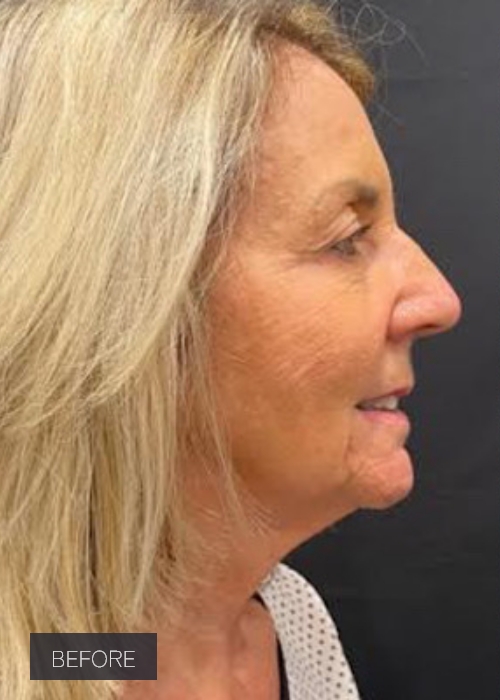 Procedure before and after - before