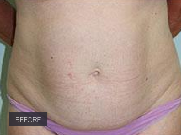 Procedure before and after - before