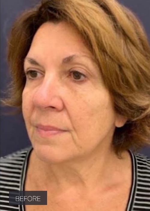 Procedure before and after - before