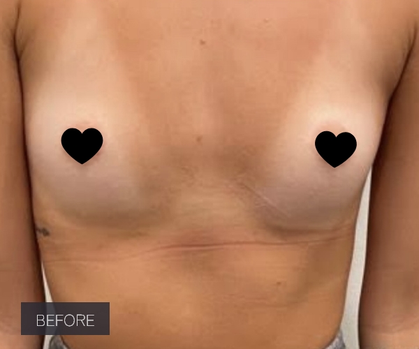 Procedure before and after - before