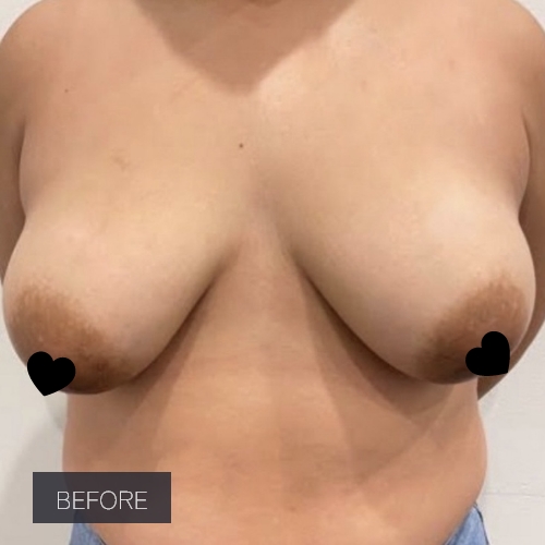 Procedure before and after - before
