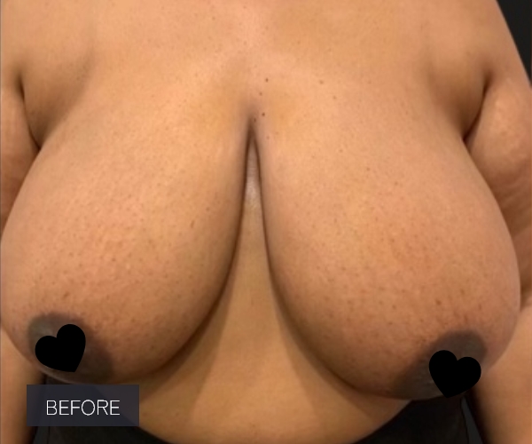 Procedure before and after - before