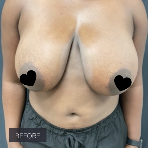 Procedure before and after - before