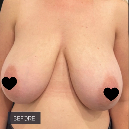 Procedure before and after - before