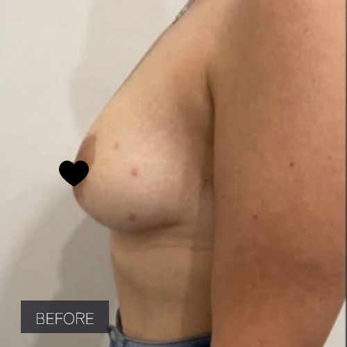 Procedure before and after - before
