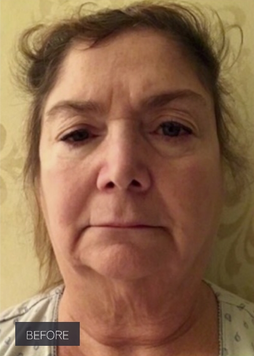 Procedure before and after - before