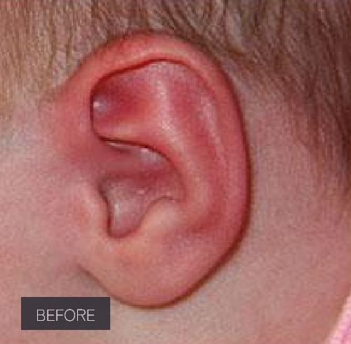 Procedure before and after - before
