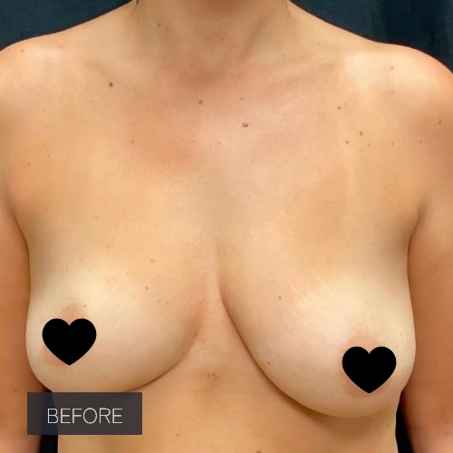 Procedure before and after - before