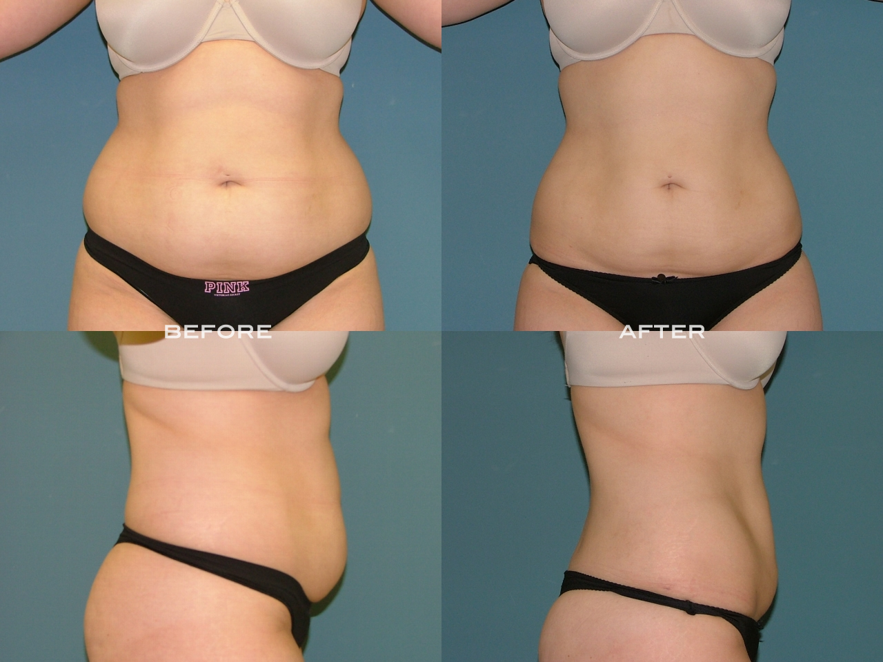 Liposuction before and after - after