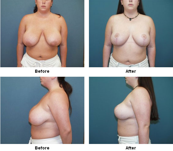 Breast Reduction before and after - after