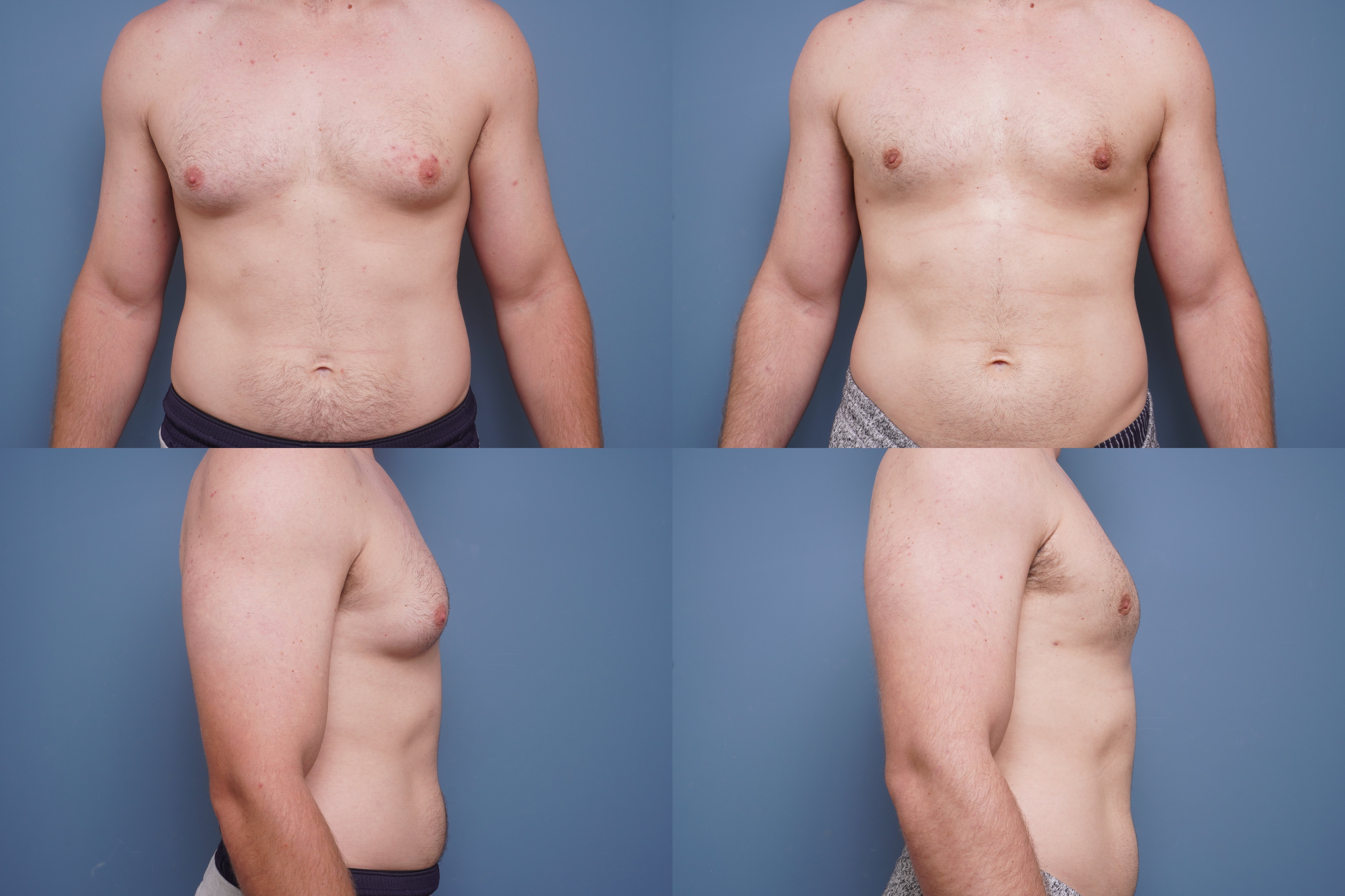 Gynecomastia before and after - after