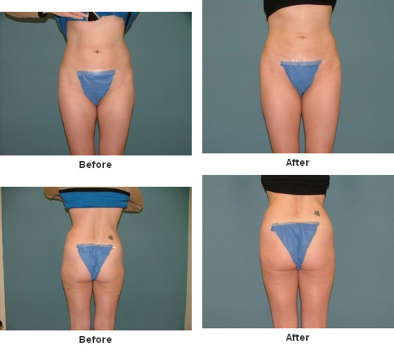 Liposuction before and after - after