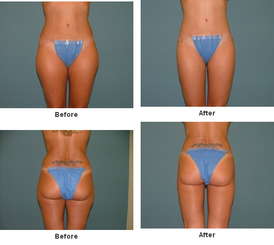 Liposuction before and after - after
