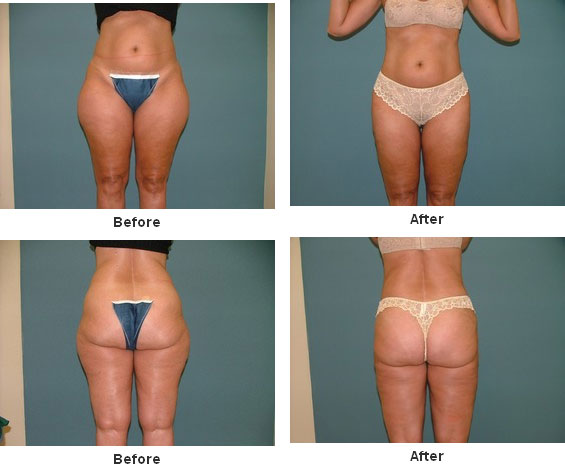 Liposuction before and after - after