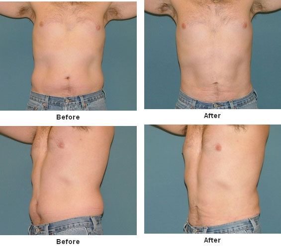 Liposuction before and after - after
