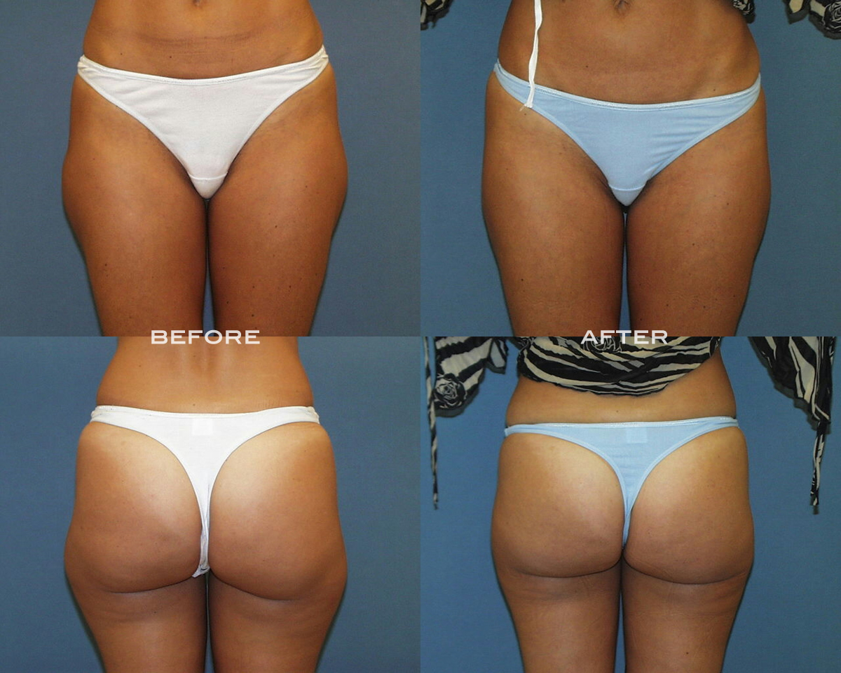 Liposuction before and after - after