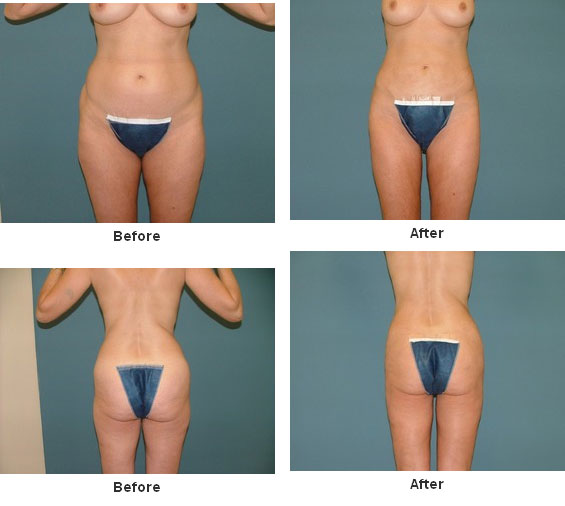 Liposuction before and after - after
